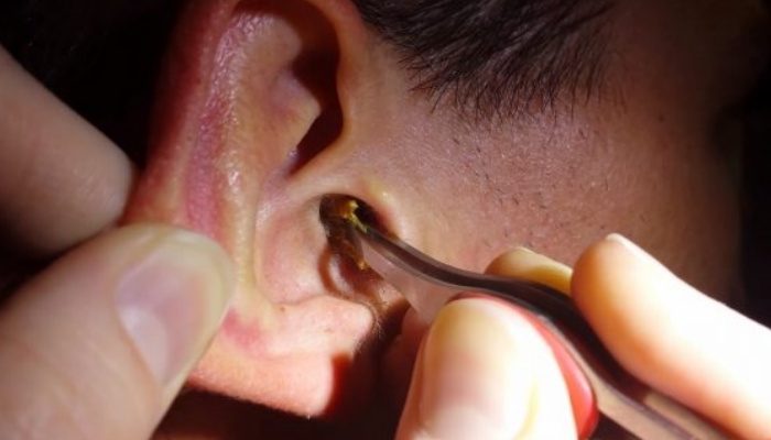 Côn trùng chui vào tai: Xử lý như thế nào?