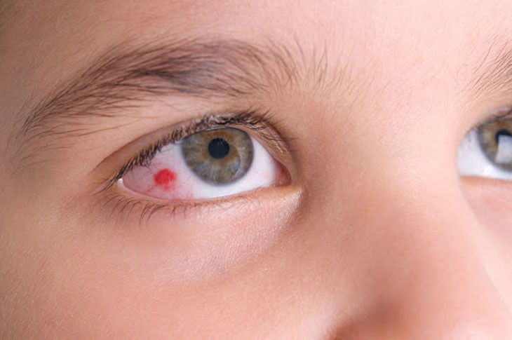 Khi nào cần tìm đến bác sĩ khi mắt bị đỏ như máu?
