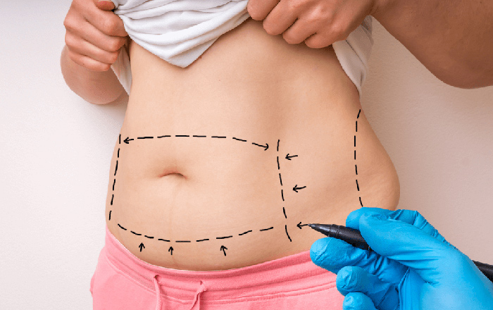 Phẫu thuật căng da bụng: Quy trình thực hiện và những điều cần lưu ý
