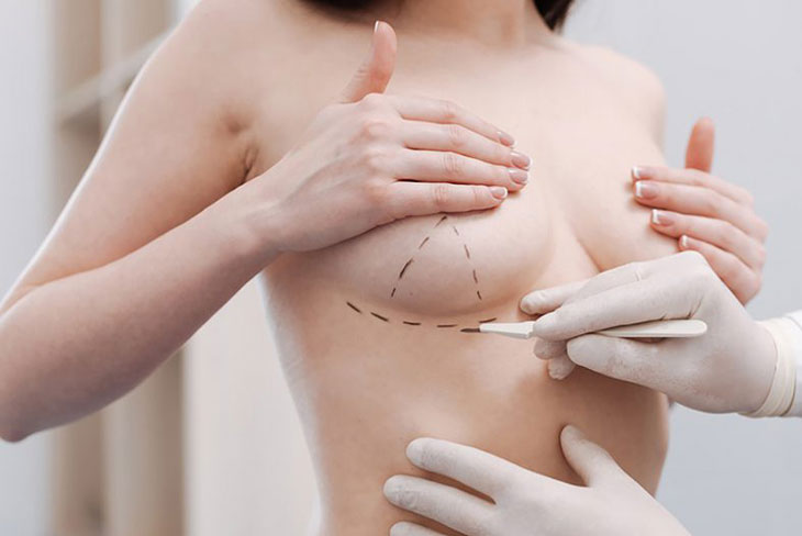 Phẫu thuật nâng ngực nội soi