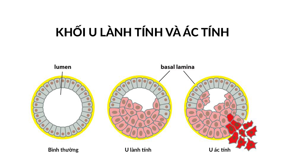 Khối u lành tính và ác tính