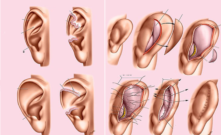 phẫu thuật tạo hình vành tai