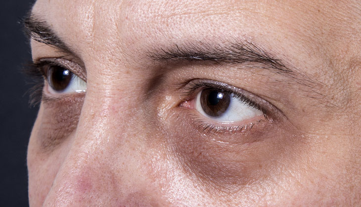 Bên cạnh phù gan, còn những nguyên nhân nào khác dẫn đến bọng mắt to thâm đen?
