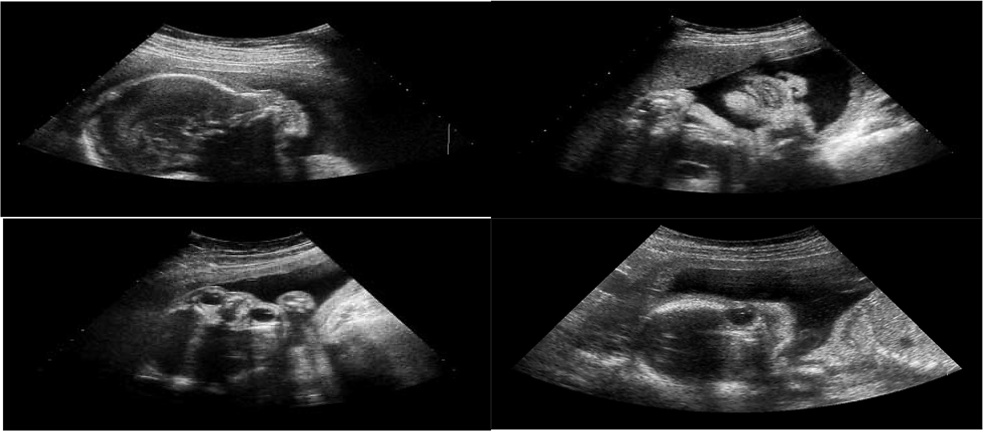 Hình ảnh siêu âm bộ phận sinh dục của thai nhi 1215 tuần