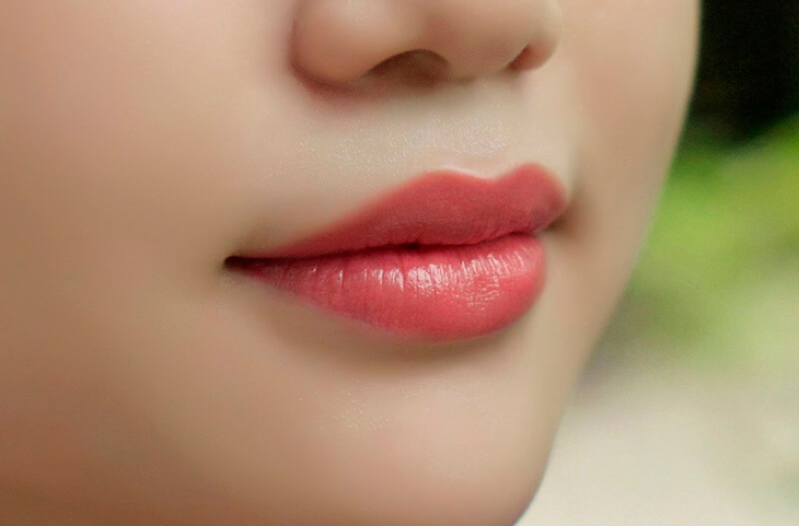 Phẫu thuật thu gọn môi tại Thẩm mỹ Hồng Ngọc