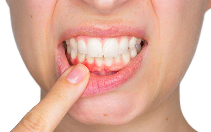 Bị tụt lợi do chải răng không đúng cách