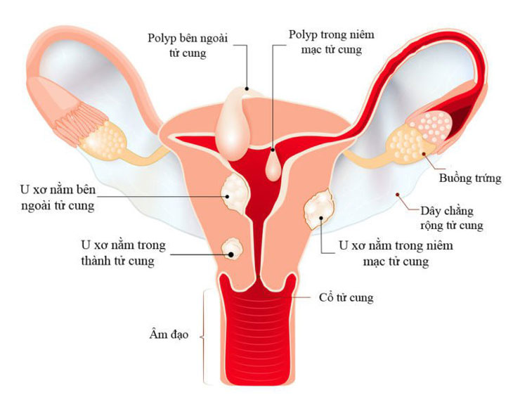 Bệnh học u xơ tử cung ⋆ Hồng Ngọc Hospital