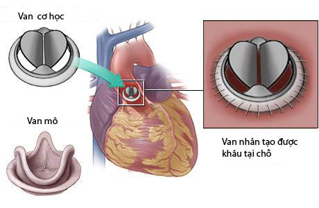 Bệnh hở van tim và phương pháp điều trị