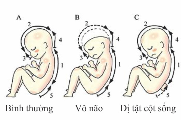 Cách ngăn ngừa dị tật ống thần kinh ở thai nhi mẹ bầu cần lưu ý