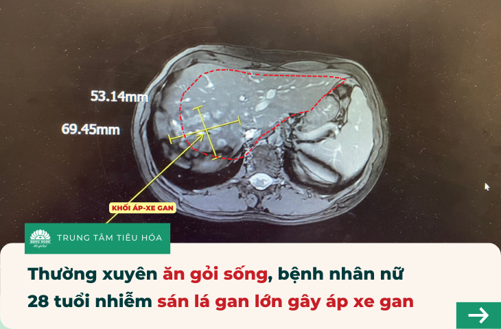 Sán lá gan: Thông tin cần biết và cách phòng tránh