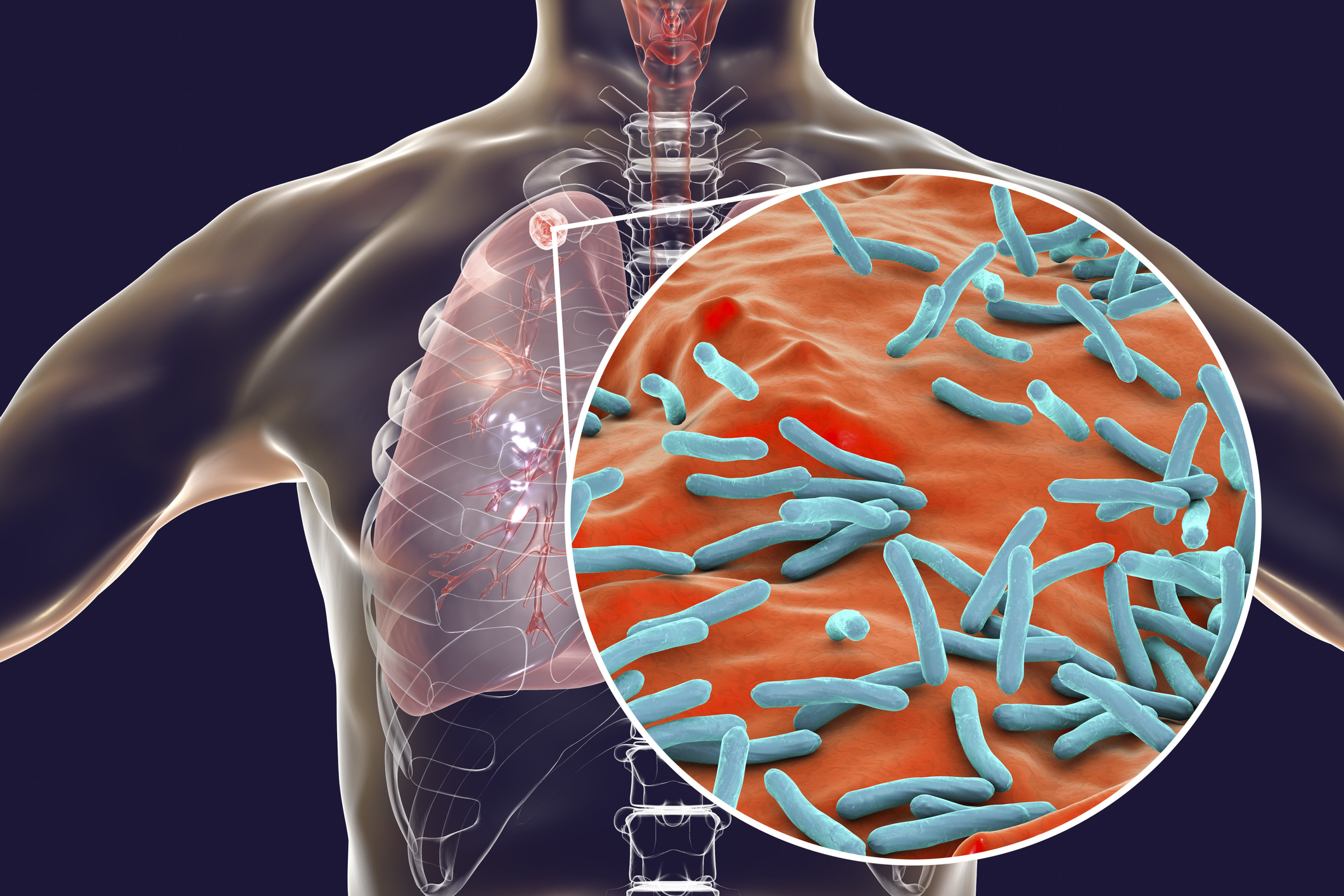 What Is The Causative Organism Of Tuberculosis