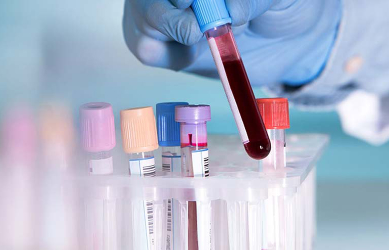 Xét nghiệm máu chẩn đoán viêm gan A
