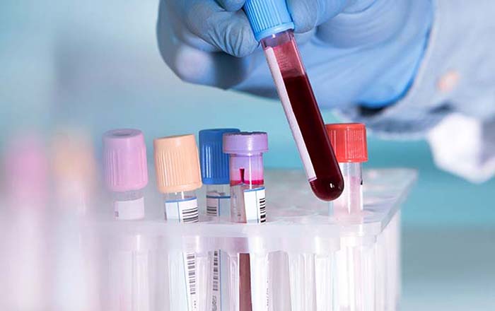 Tìm hiểu rapid urease test là gì để phát hiện nhiễm khuẩn HP trong dạ dày