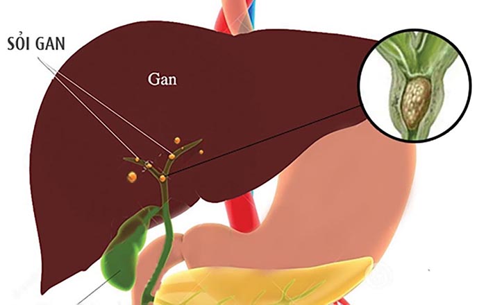 Sỏi mật trong gan: Nguyên nhân, triệu chứng, phương pháp điều trị và phòng ngừa