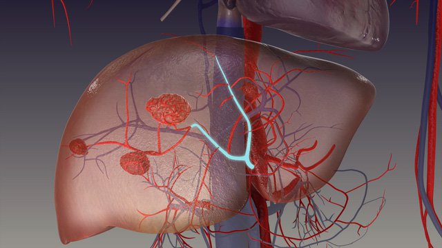 Hemangioma Gan: Nguyên Nhân, Triệu Chứng và Cách Điều Trị Hiệu Quả