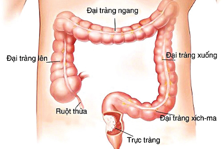 Bệnh U Trực Tràng: Nguyên Nhân, Triệu Chứng và Phương Pháp Điều Trị