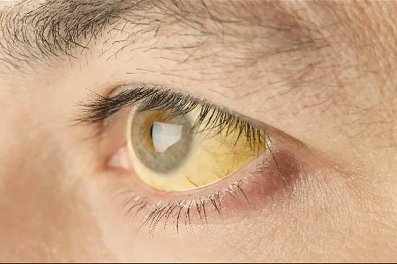 Vàng mắt, vàng da là triệu chứng điển hình của viêm gan