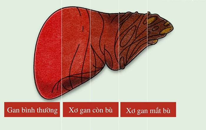 Sự tiến triển của xơ gan giai đoạn nặng?
