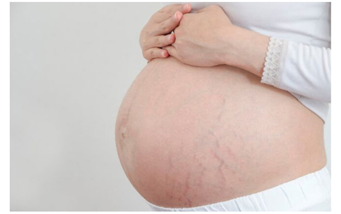Thuốc chứa axít azelaic có hiệu quả trong việc trị mụn khi mang bầu hay không?
