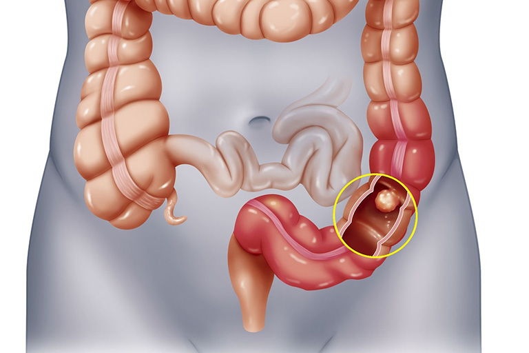 Đau bụng bên phải là dấu hiệu của bệnh gì?