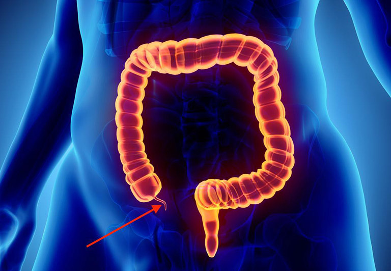 Đau bụng bên phải phía dưới là một trong những triệu chứng cảnh báo sớm bệnh viêm ruột thừa
