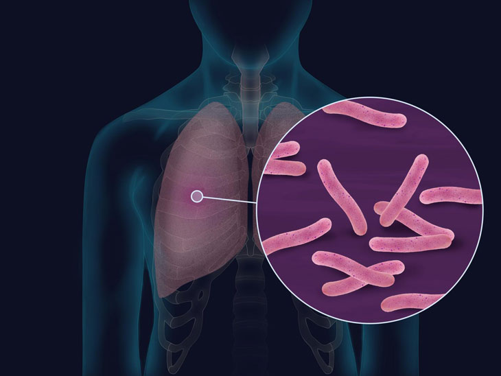 Dấu hiệu nhận biết bệnh lao phổi là gì?