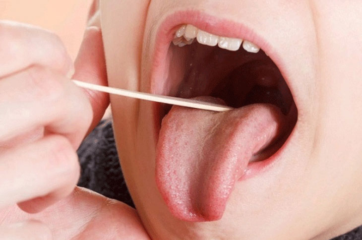 Làm thế nào để giảm đau họng rát lưỡi?
