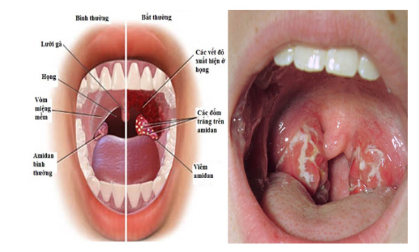 amidan viêm gây đờm trong cổ họng