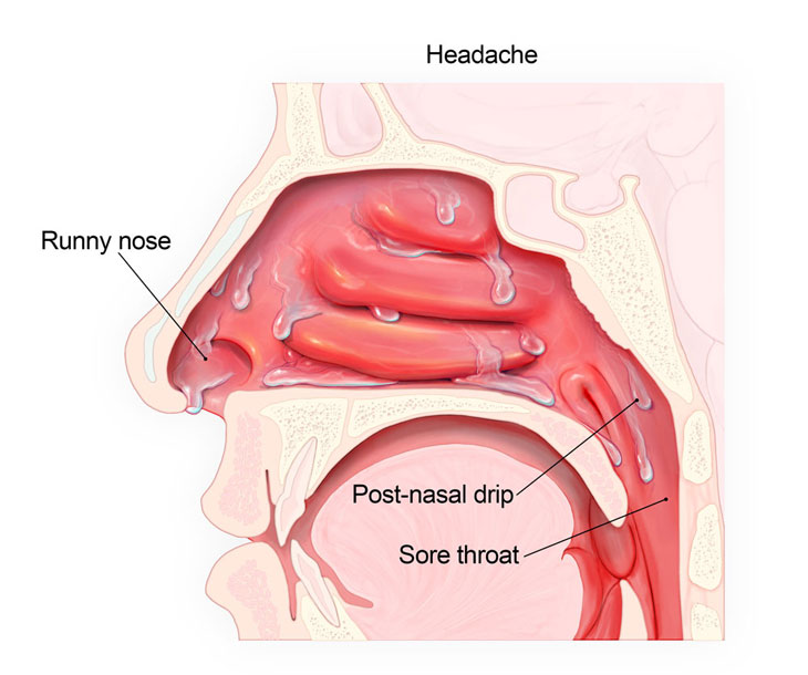 Dịch mũi chảy xuống họng: Nguyên nhân do đâu?