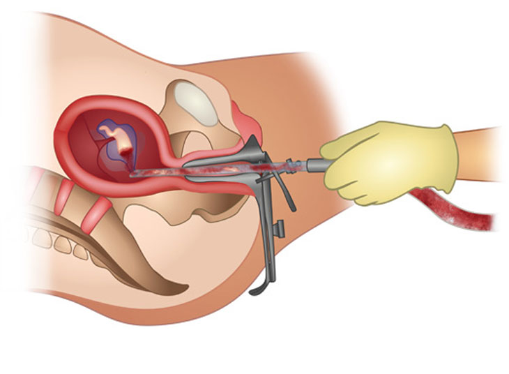 Sau quá trình hút thai, có những biểu hiện nào thường gặp?
