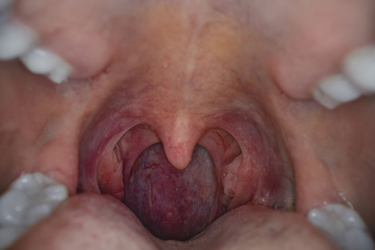ung thư vòm họng