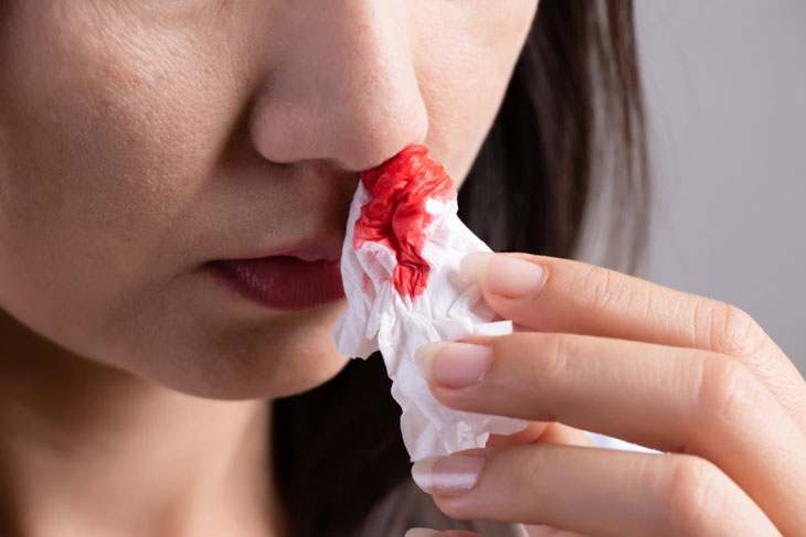 Dịch mũi có máu: Nguyên nhân gây ra là gì?