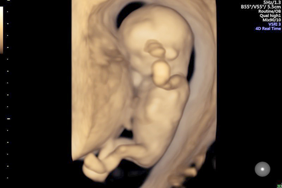 Khám thai 12 tuần bằng siêu âm 4D