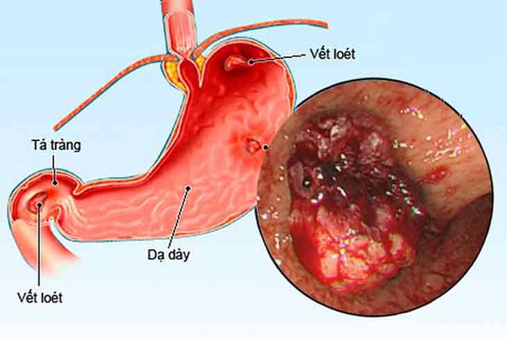 1. Tổng Quan Về Trào Ngược Dạ Dày