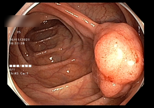 Bệnh nhân nữ 35 tuổi tránh được nguy cơ ung thư đại tràng nhờ nội ...