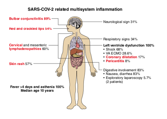 Hội chứng viêm đa hệ thống hậu COVID-19 ở trẻ em