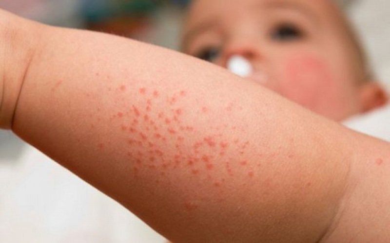 triệu chứng sốt xuất huyết ở trẻ em