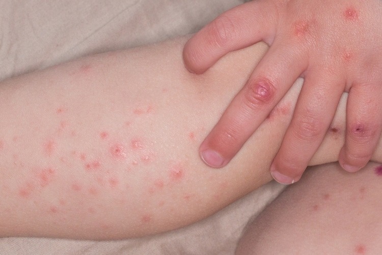 Trẻ bị tay chân miệng không sốt có nguy hiểm không?