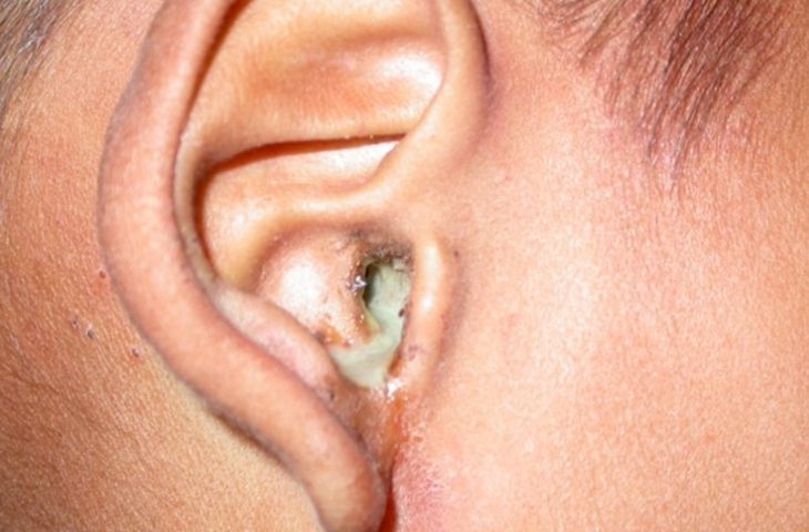 Ngứa lỗ tai trái khoáy, cần vẹn toàn nhân vì thế đâu? Cách hành xử chất lượng tốt nhất