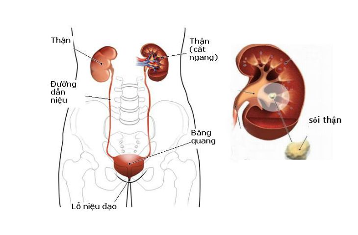 Nam giới và nữ giới đều có thể mắc sỏi niệu đạo không?
