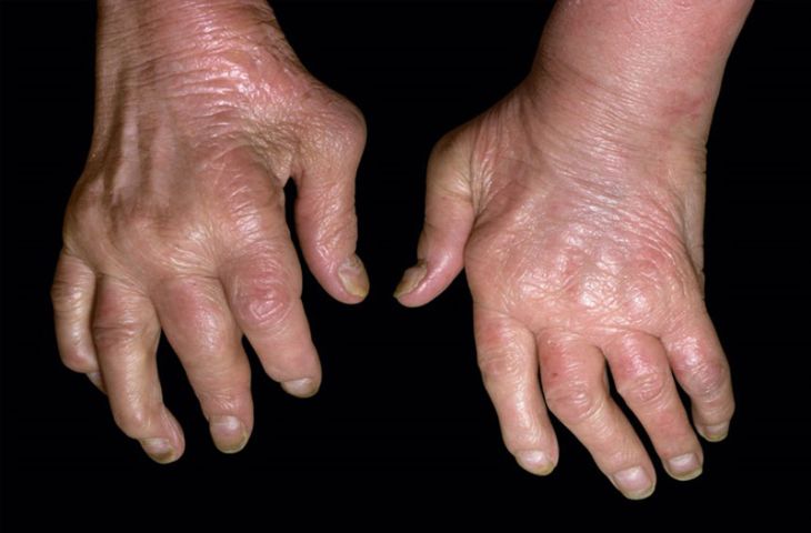 Gout làm thế nào để chẩn đoán?
