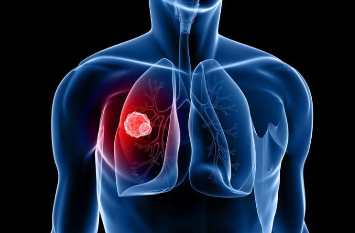 Tầm soát ung thư phổi là việc làm cần thiết giúp phát hiện bệnh sớm và có cơ hội điều trị khỏi bệnh.
