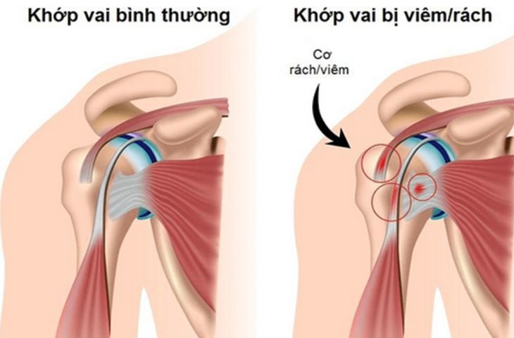 Triệu chứng chính của bệnh viêm khớp vai là gì?
