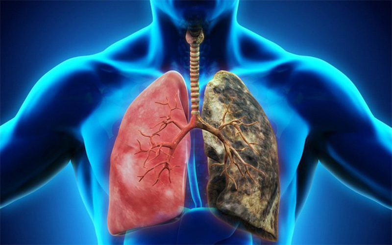 Triệu chứng ung thư phổi giai đoạn đầu không phải ai cũng nhận ra là gì?
