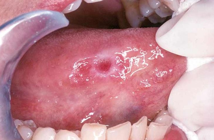Có những loại bệnh lý nào liên quan đến khoang miệng? 

