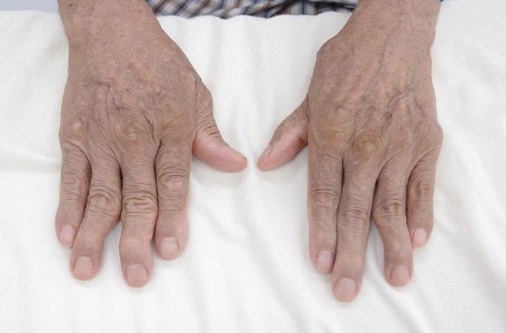 Viêm khớp dạng thấp dẫn đến biến dạng khớp ở bàn tay