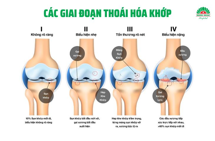 thoái hóa khớp gối