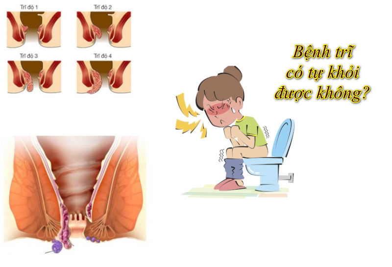 Những nguyên nhân gây ra trĩ ngoại độ 2 là gì?
