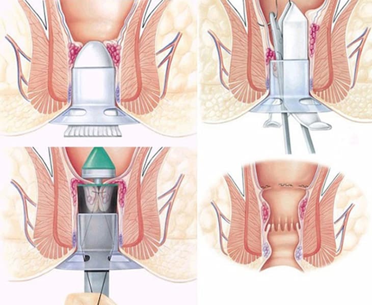 Phương pháp cắt trĩ Longo giúp bệnh nhân ít đau hơn, phục hồi nhanh