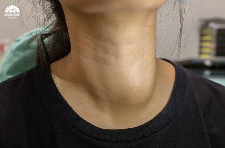 Tuyến giáp phát triển nhanh gây biến dạng vùng cổ cần phẫu thuật tuyến giáp